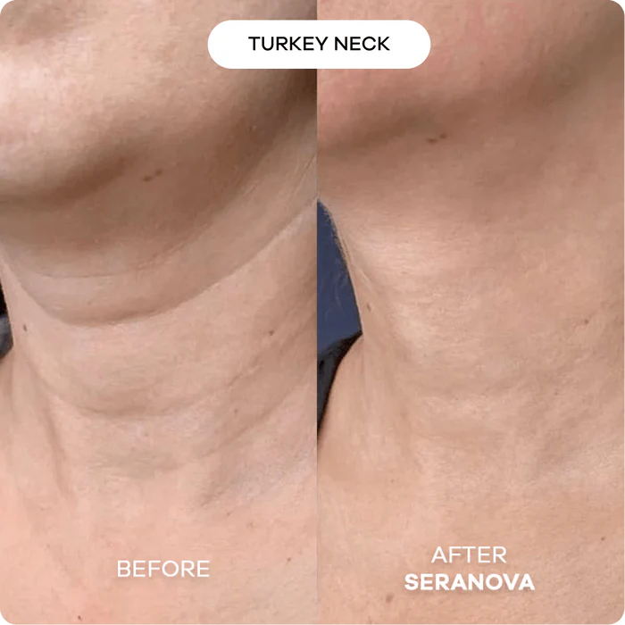 The Microneedling Infusion System