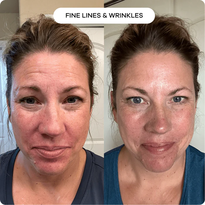 The Microneedling Infusion System