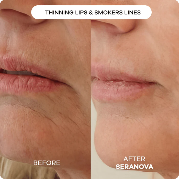 The Microneedling Infusion System