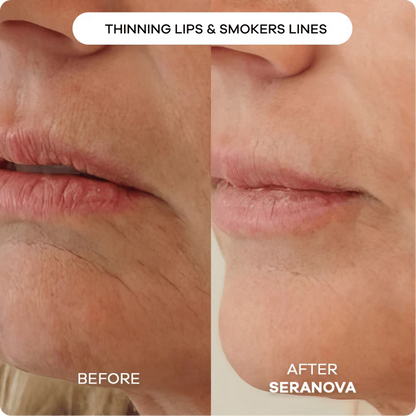 The Microneedling Infusion System