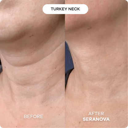 The Microneedling Infusion System